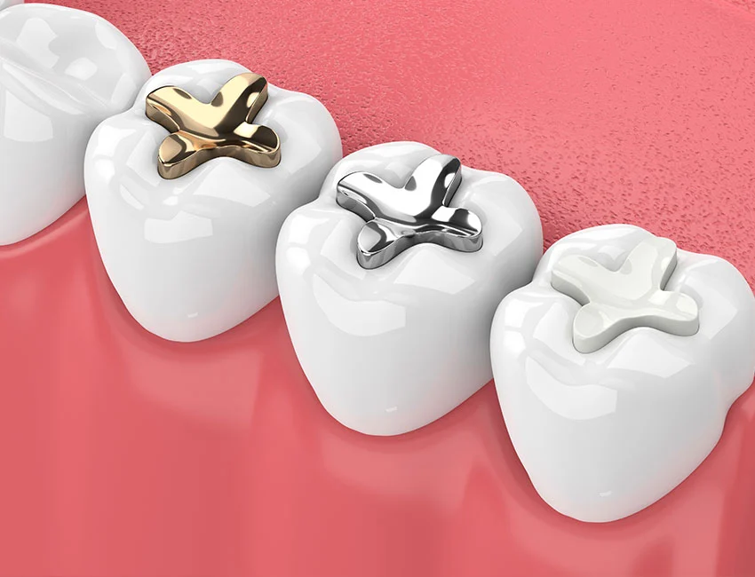 Amalgam vs composite dental fillings