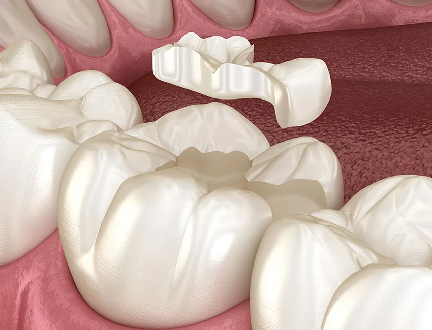 Dental Inlays and onlays or porcelain fillings