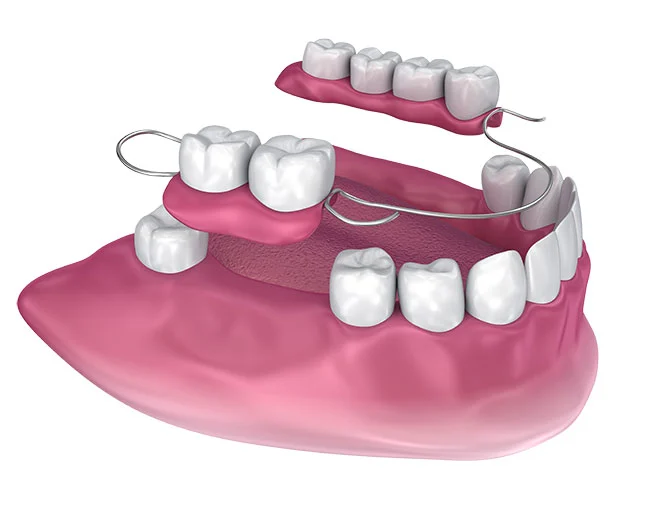 Partial dentures