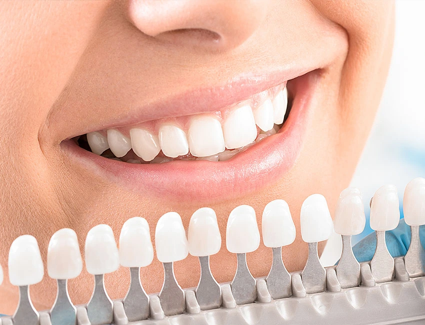 Professional Teeth Whitening