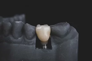 Dental implant model