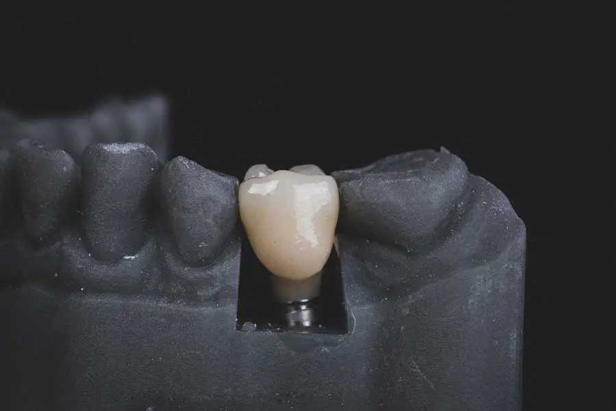 Dental implant model