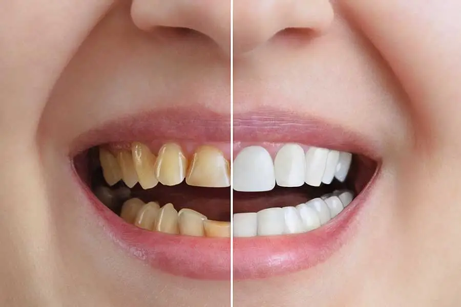 Teeth whitening before and after