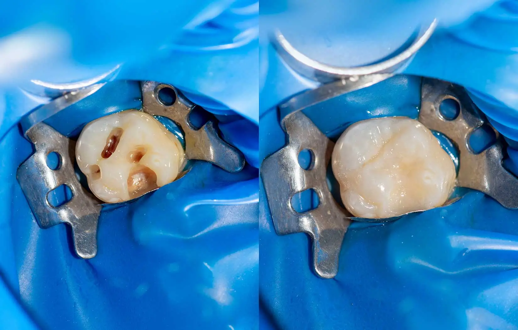 Before and after dental fillings